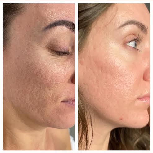 Skin Tightening in Vienna, VA