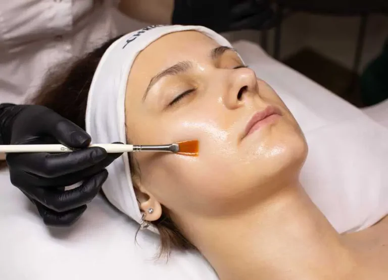 Chemical Peels Treatment by Dermestetics in Vienna, VA