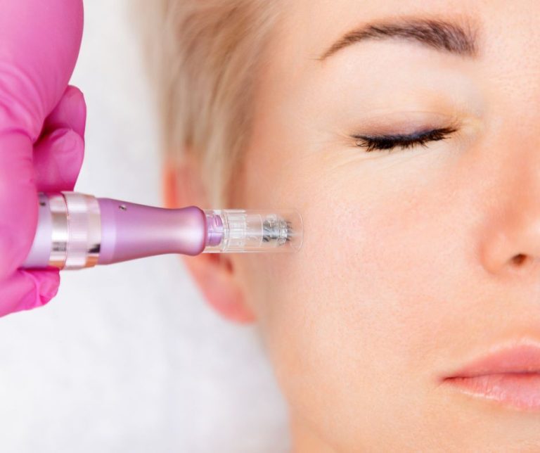 Dermestetics - RF Microneedling in Arlington, VA