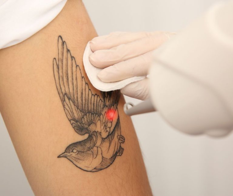 Dermestetics - Laser Tattoo Removal Near Me Vienna, VA