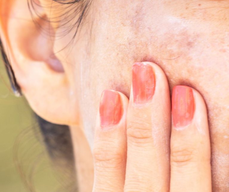 Dermestetics - Effective Hyperpigmentation Treatment Options