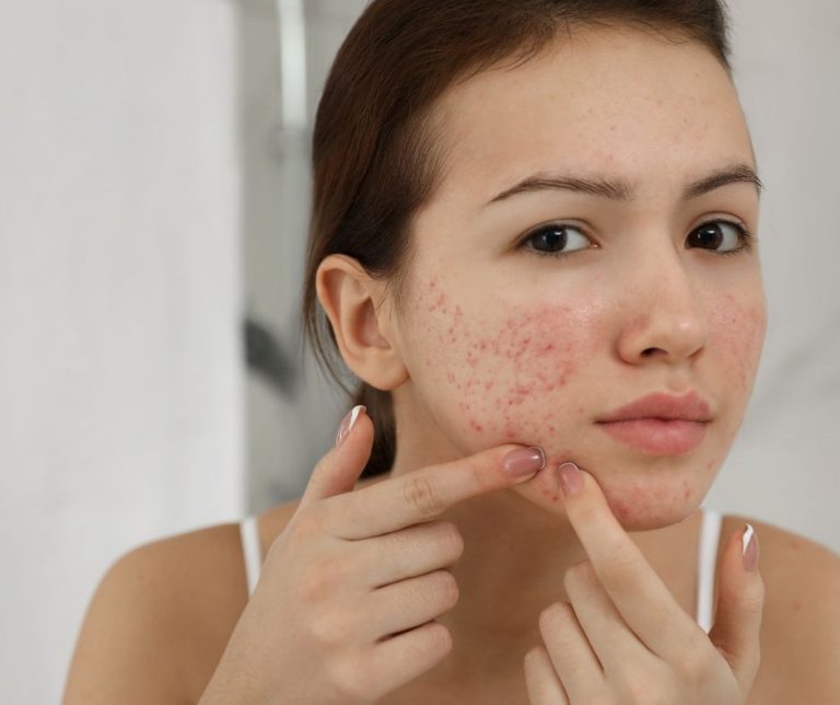 Dermestetics - Acne Treatments in Arlington VA