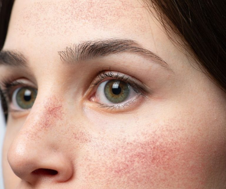 Dermestetics - Rosacea Treatments in Arlington, VA