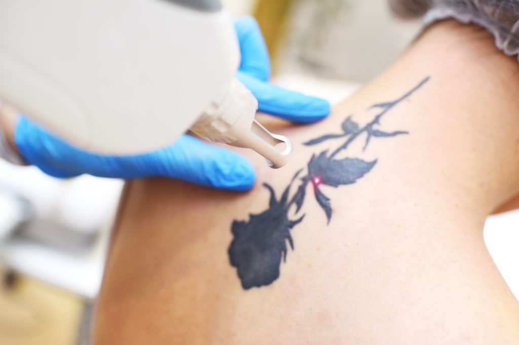 Laser Tattoo Removal in Warrenton VA