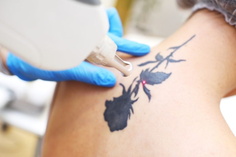Laser Tattoo Removal in Warrenton VA