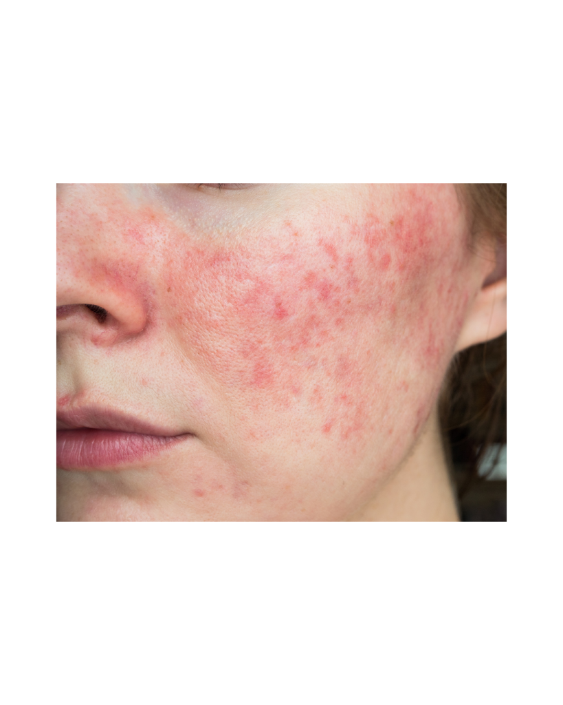 Dermestetics - Rosacea in Vienna VA