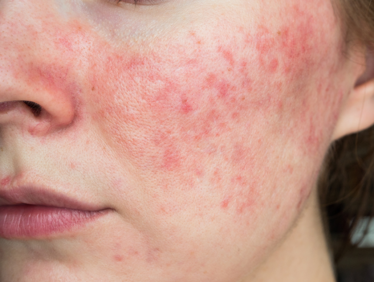 Dermestetics - Rosacea in Vienna VA