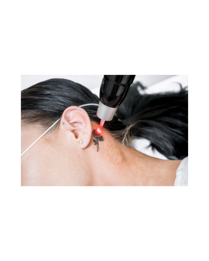 Dermestetics - Tattoo Removal in Vienna VA