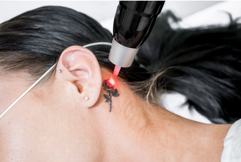 Dermestetics - Tattoo Removal in Vienna VA