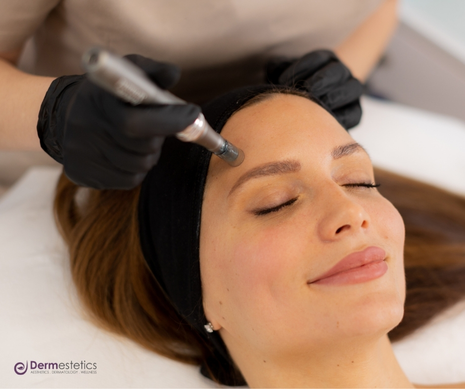 Dermestetics Microneedling in Arlington